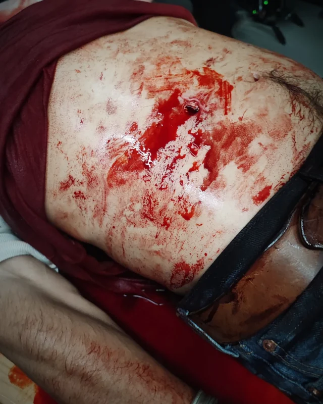 ❗️Prosthetic Make-up❗️
•
„Love Sucks“ 2023
@zdfneo @studio_zentral 
•
Belly covering silicone prosthetic for a treatment of a shot wound in the guts scene, that we created on Stipe Erceg. The integrated blood system allowed steady bleeding on camera. 
•
Make-up effects design by 
@twilightcreations 
Tamar Aviv & Jörn Seifert,
Sculpted by @julianhutcheson 
Moldmaking Magnus Hjeldnes
Silicone running by @lalax_ro und Kerstin Buss
Paintjob by @julietteruetz 
Hair punching by @julianhutcheson 
Application on set by Jörn Seifert and @2nd.skin.transfer_art 
•
Thank you to department head @baumann_steffi for having us on board . 
•
#lovesucks #prosthetics #silicone #therewillbeblood #zdf #realisticarts #painting🎨 #shotwound #mouldmaking #sculpting #hyperrealidtc #surgerymakeup #twilightcreations #vampiremakeup #setlife🎬 #vampirehunter 
#specialmakeupeffects #specialeffectmakeup #fxmakeupartist #sfxwounds #sfxgore #sfxmakeupart #sfxmakeuptutorial #makeupeffect #specialmakeupfx #specialmakeup #prostheticlimbs