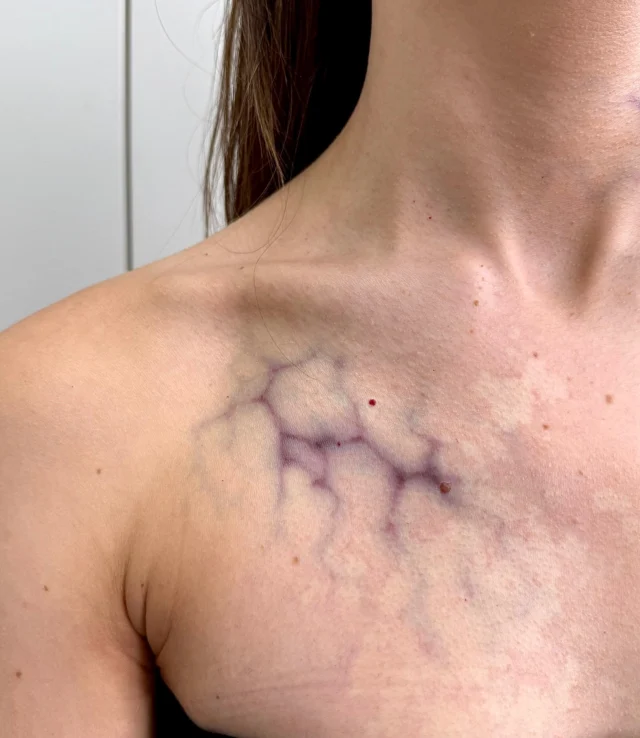 ❗️ Tattoo Transfer ❗️
•
Some new vein designs we will be adding to our store @twilightcreations_shop soon!! 
•
#tattootransfer #prosthetics #silicone #faketattoos #tattoosforfilm #realisticart #veinsart #makingtattoos #mouldmaking #sculpting #hyperrealism #halloweentattoos #zombieveins #halloweenmakeupideas 
#twilightcreations #halloweeninspo #setlife🎬 #halloweeninspiration 
#specialmakeupeffects #specialeffectmakeup #fxmakeupartist #sfxwounds #sfxgore #sfxmakeupart #sfxmakeuptutorial #makeupeffect #specialmakeupfx #specialmakeup