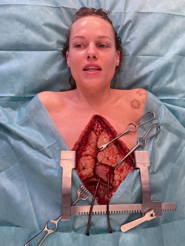 ❗️ Silicone Prosthetic❗️
•
An autopsy overlay prosthetic for make-up and hair designer @helene.lang.makeuphair.artist for the movie “Welcome home Baby”
•
Make up effects design by @twilightcreations 
Sculpted by 
@jordi_morera_studio 
Moulding by
@dennis.penkov 
Silicone running and blood rig fabrication by @lalax_ro , @komplemagnus 
Painted by 
@julianhutcheson 
Application and maintenance on set by 
@helene.lang.makeuphair.artist , @hannahfischleder 
•
#autopsy #prosthetics #silicone #welcomehomebaby #pathologist #realisticart #surgerytime #intestines #mouldmaking #sculpting #hyperrealism #makeupeffects #makeupfxartist #prosthetic 
#twilightcreations #prostheticeffects #setlife🎬 #prostheticdesigner 
#specialmakeupeffects #specialeffectmakeup #fxmakeupartist #sfxwounds #sfxgore #sfxmakeupart #sfxmakeuptutorial #makeupeffect #specialmakeupfx #specialmakeup