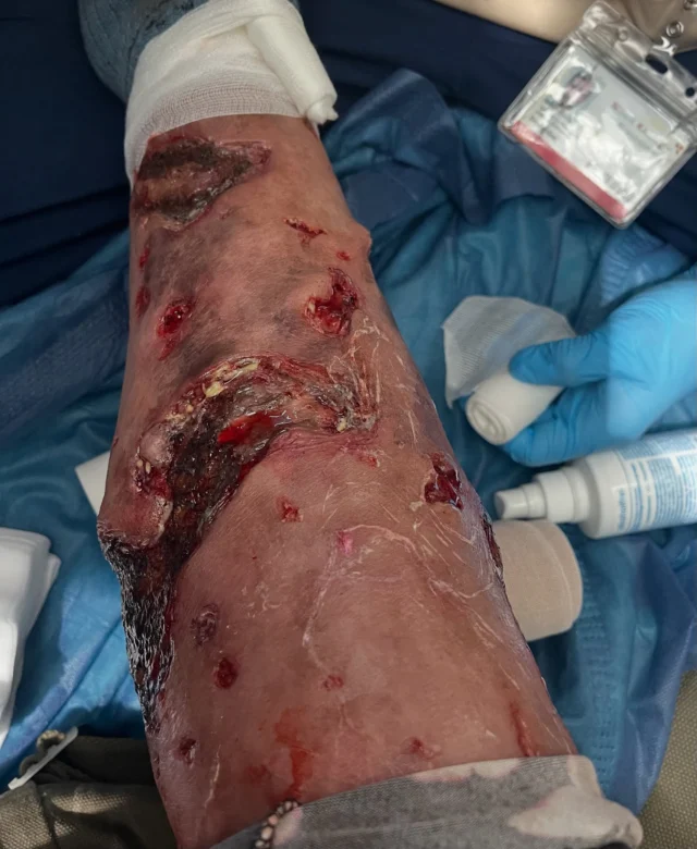 ❗️ Silicone Prosthetic❗️•A serious and in some parts necrotic leg infection prosthetic(due to drug abuse and life on the streets) we created for make-up and hair designer @ank_makeupartist for the first season of “KraNK Berlin”•Make up effects design by @ank_makeupartist and @twilightcreations Sculpting, moulding and silicone running  by @komplemagnus Seaming@julianhutcheson Painting and art finishing by Tamar AvivApplication and maintenance on set by Tamar & @julietteruetz Jörn & @2nd.skin.transfer_art •Thank you @ank_makeupartist for having us on board 🙏🏼•#necrotic #prosthetics #silicone #krankberlin #woundcarenurse #realisticart #surgerytime #drugabuse #mouldmaking #sculpting #hyperrealism #makeupeffects #makeupfxartist #prosthetic #twilightcreations #prostheticeffects #setlife🎬 #prostheticdesigner #specialmakeupeffects #specialeffectmakeup #fxmakeupartist #sfxwounds #sfxgore #sfxmakeupart #sfxmakeuptutorial #makeupeffect #specialmakeupfx #specialmakeup